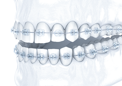ブラケット矯正